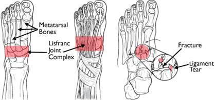 diagram of the metatarsal bones and Lisfanc Joint Complex