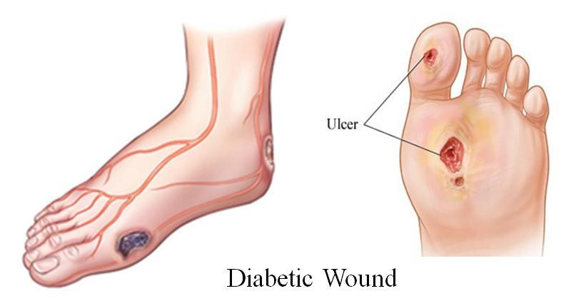 diagram of diabetic ulcers on the side, back and underside of the foot and underneath the big toe