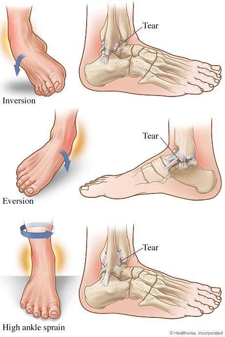 Diagram of different types of ankle sprains - inversion, eversion, and high ankle sprain