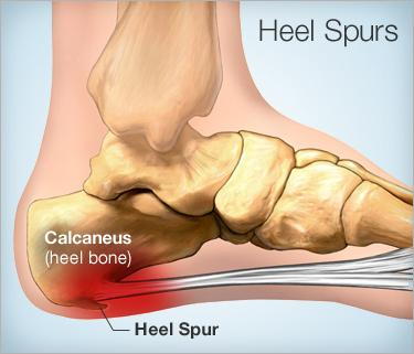 diagram of foot bones with a heel spur highlighted in red