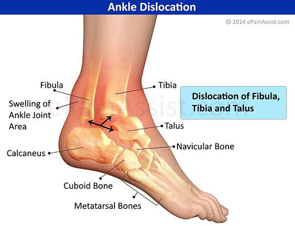 diagram of the bones in the foot , ankle and lower leg and where swelling occurs when the ankle is dislocated