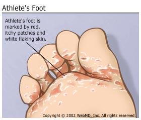 drawing of a foot with Athlete's foot marked by red, itchy patches and white flaking skin