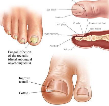 diagram of the parts of the toe and toenail, a toenail with fungal infection, and an ingrown toenail