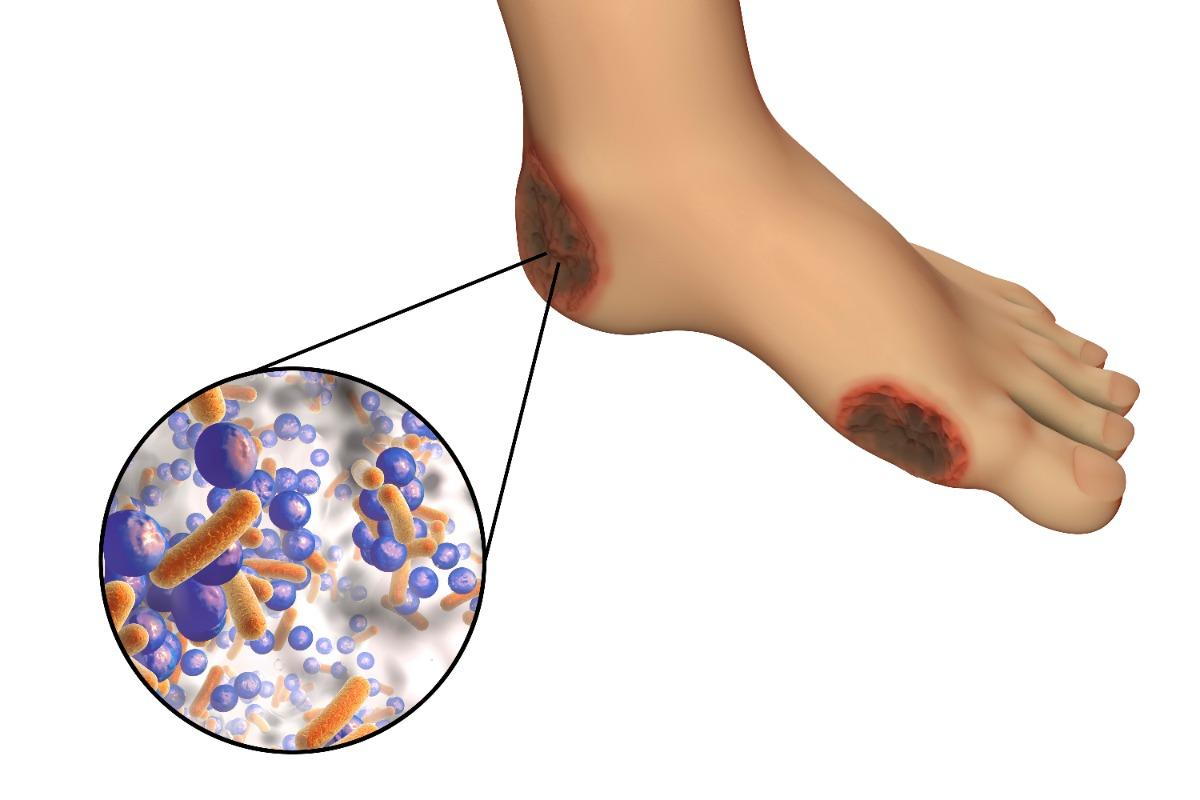 diagram of bacteria and dark red areas on the side and back of the foot affected by bacterial infections