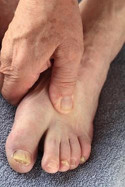 person with yellow toenails rubbing their foot