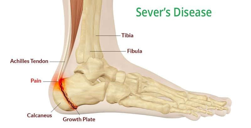 diagram of the foot, heel and ankle showing swelling and irritation of the growth plate in the calcaneus (heel)